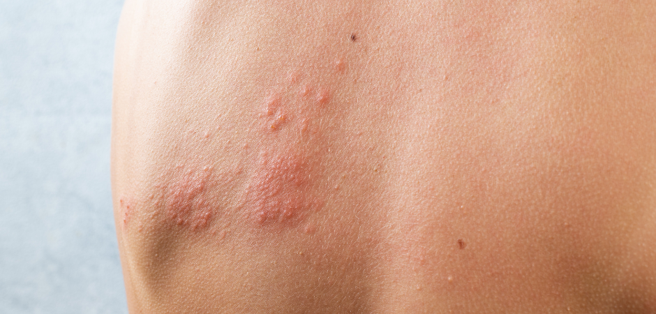 Alleviare il dolore dell'herpes zoster con l'agopuntura.